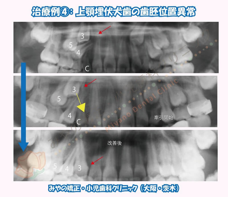 犬歯埋伏治療例④:上顎埋伏犬歯の歯胚位置異常