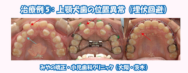 犬歯埋伏治療例⑤:上顎犬歯の位置異常(埋伏回避)