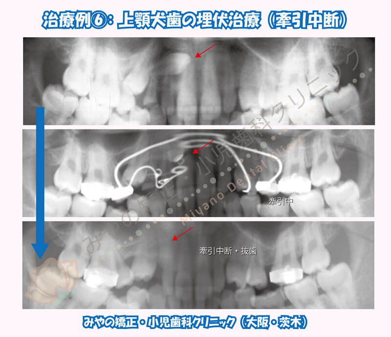 犬歯埋伏治療例⑥:上顎犬歯の埋伏治療(牽引中断)
