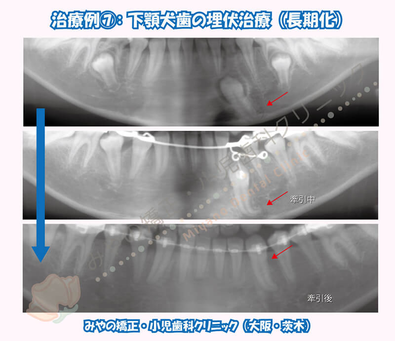 犬歯埋伏治療例⑦:下顎犬歯の埋伏治療(長期化)