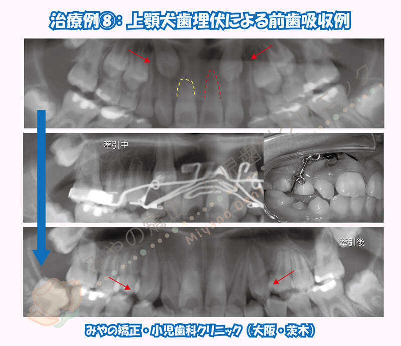犬歯埋伏治療例⑦:下顎犬歯の埋伏治療(長期化)