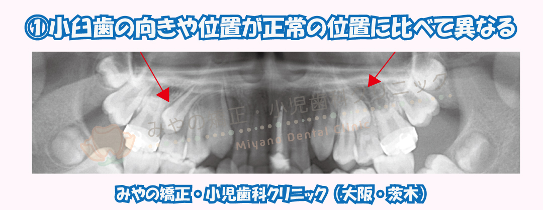 ①小臼歯の向きや位置が正常の位置に比べて異なる