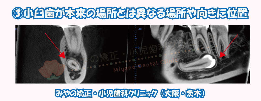 ③小臼歯が本来の場所とは異なる場所や向きに位置している