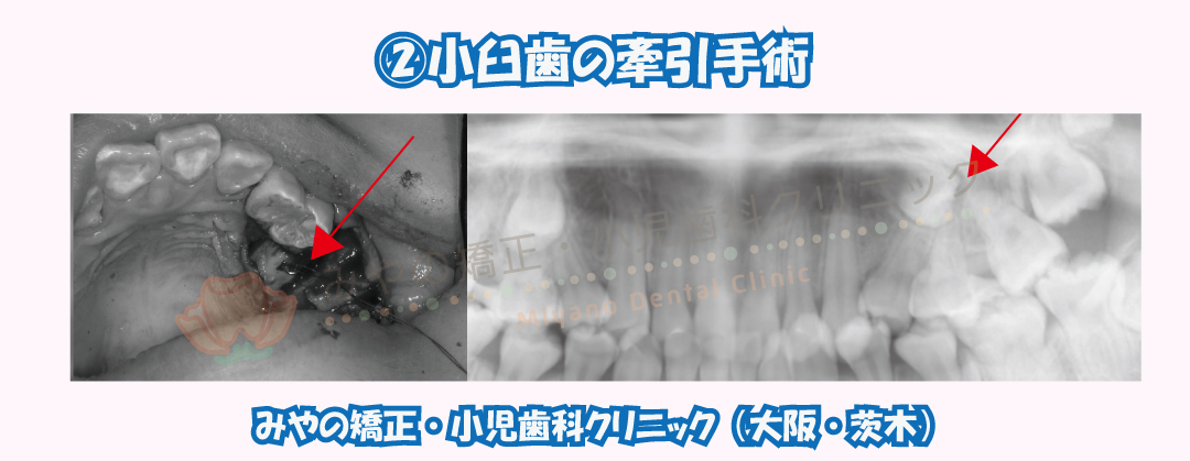②小臼歯の牽引手術
