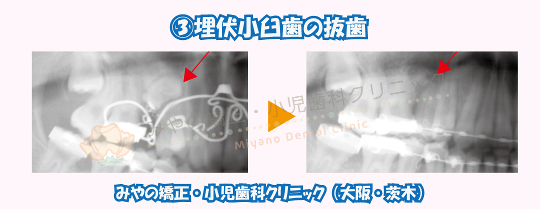 ③埋伏小臼歯の抜歯