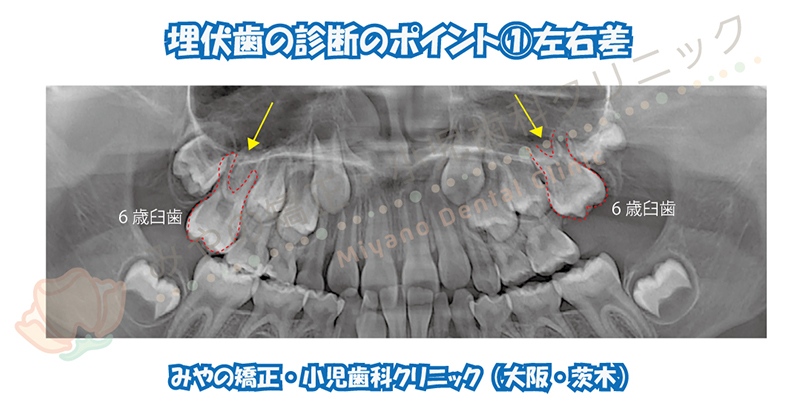 埋伏歯の診断のポイント ①左右差