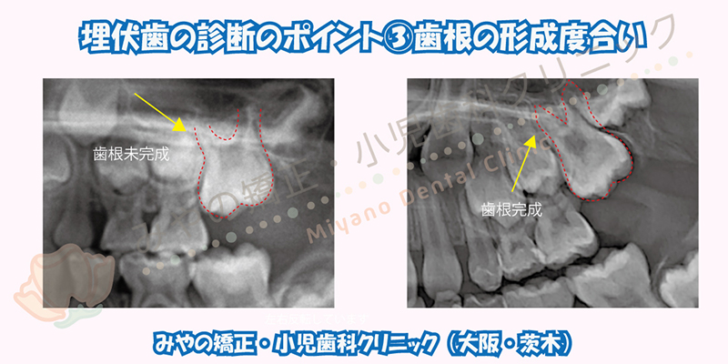 埋伏歯の診断のポイント ③歯根(歯の根っこ)の形成度合い
