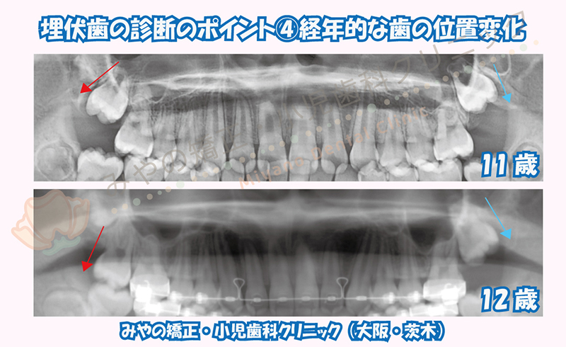 埋伏歯の診断のポイント ④経年的な歯の位置変化