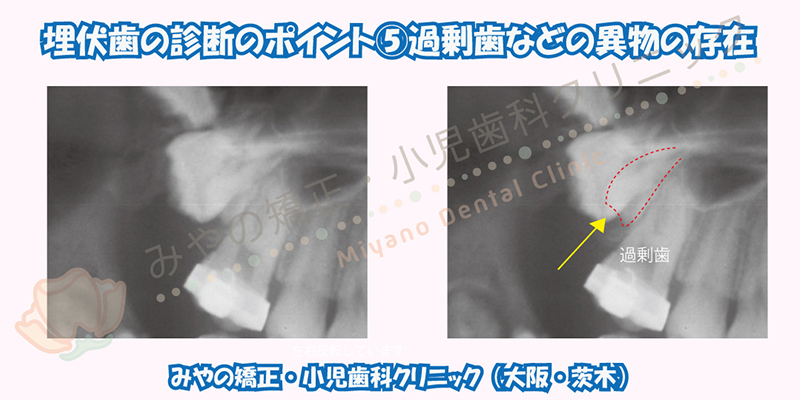 埋伏歯の診断のポイント ⑤過剰歯や腫瘍などの異物の存在