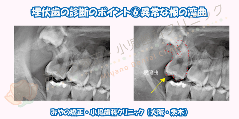 埋伏歯の診断のポイント ⑥異常な根の湾曲